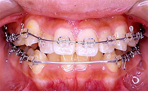 Ⅱ期治療（永久歯列期：すべて永久歯にはえかわってから）