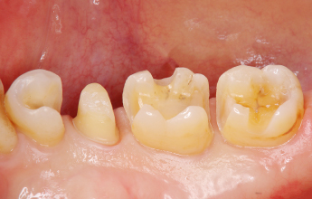 GUM DISEASE 歯周病治療