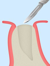 STEP1 歯茎を切開する