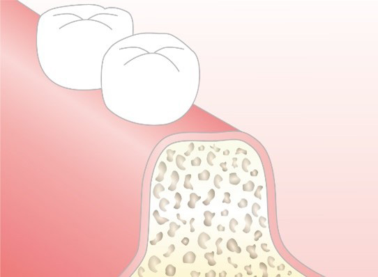 Step 3 骨補填材の成熟