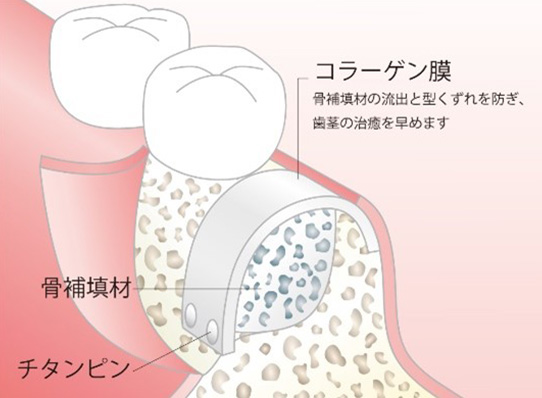 Step 2 骨補填材の填入と縫合