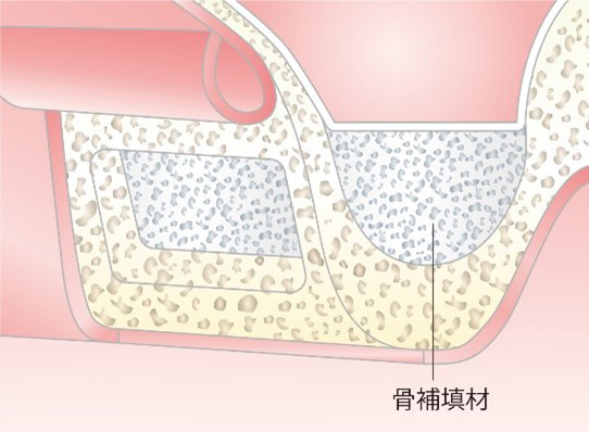 Step 3 インプラント体の埋入