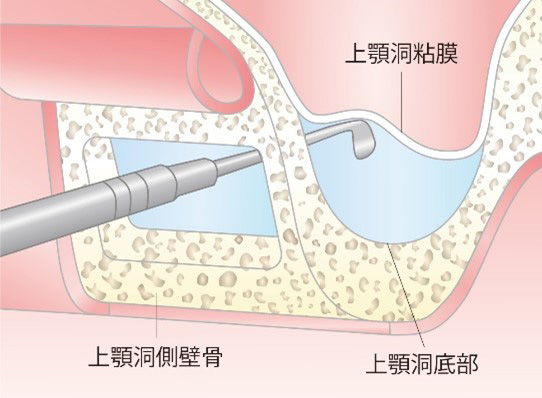 Step 1 上顎洞側壁骨の除去と上顎洞粘膜の挙上