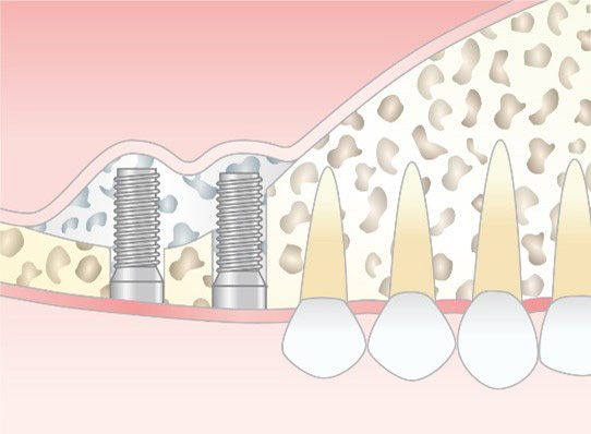 Step 2 上顎洞粘膜の挙上と骨補填材の填入