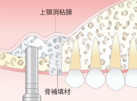 Step 3 インプラント体の埋入