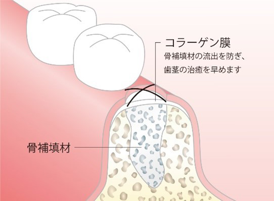 Step 3 骨補填材の成熟