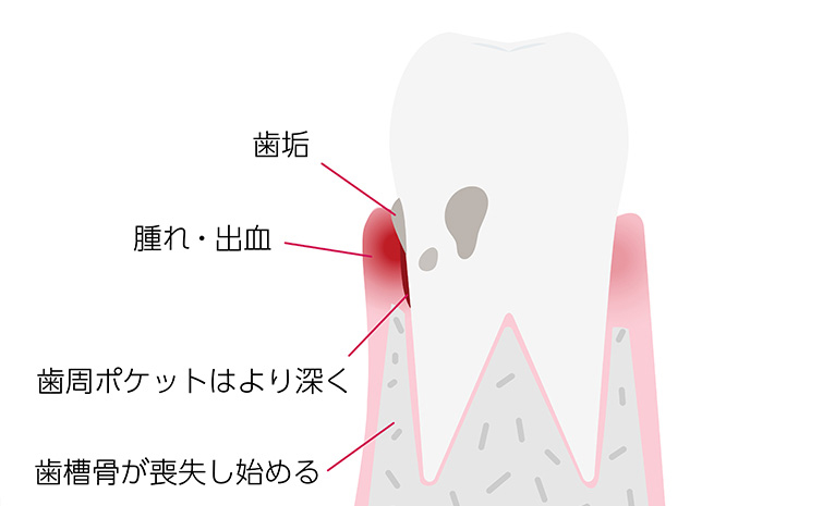 歯肉炎・軽度歯周炎