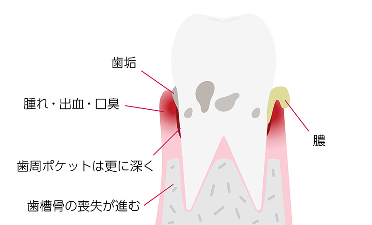 中等度歯周炎