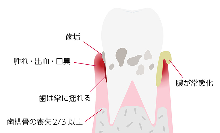 重度歯周炎