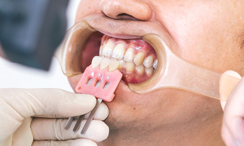 ミモデンタルクリニックと歯科技工士との連携